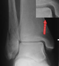 ankle medial injury