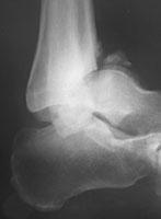 charcot ankle