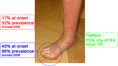 image showing prevalence of problems in rheumatoid ankle, hindfoot and forefoot