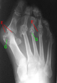 radiograph of rheumatoid foot with bone destructive lesions marked